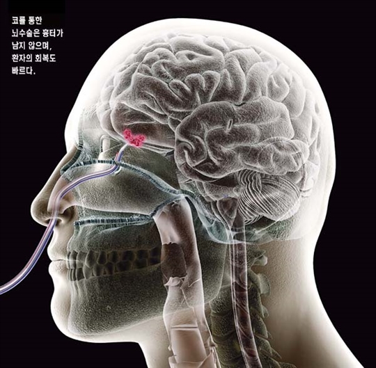 뇌 수술하는 로봇