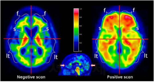 치매 음성 사진(왼쪽)과 양성 사진. 푸른색 및 초록색은 베타아밀로이드의 밀도가 낮다는 것을 의미하며 이는 곧 알츠하이머 치매의 가능성이 낮다는 것을, 주황색 및 붉은색은 베타아밀로이드의 밀도가 높은 것으로 알츠하이머 치매 가능성이 높다는 것을 보여주다. /사진제공=분당차병원