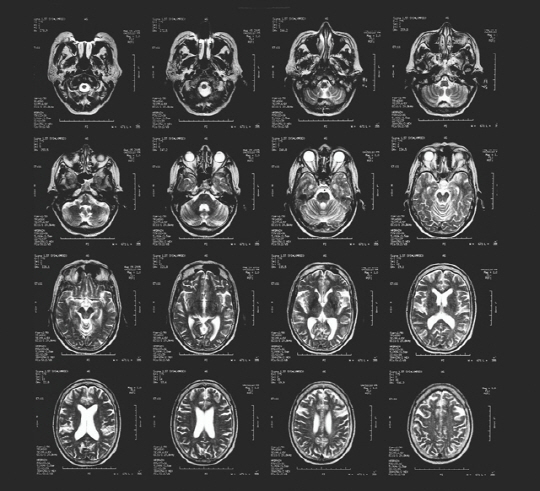 아래의 사진과 같은 뇌 스캔을 통해 사이코패스들은 충동제어와 감정처리를 담당하는 뇌 영역에 결함이 있다는 사실이 밝혀졌다.