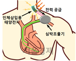 피하에 삽입된 유연 인체삽입용 태양전지가 태양광을 통해 생성된 전기에너지를 이용해 실제 사용되는 심박조율기에 전력을 공급하는 개념도/사진제공=미래창조과학부