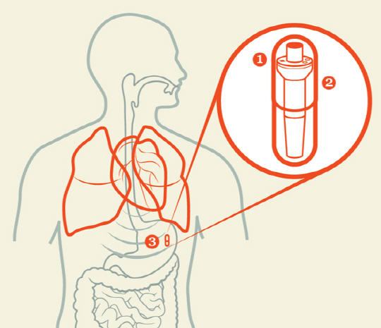 1. 알약을 삼키면 내장된 수중청음기가 심장과 폐의 소리를 탐지한다. 또한 초소형 체온계가 심부 체온을 측정한다.<BR>2. 온도와 소리 데이터가 의사의 컴퓨터로 전송된다. 소리 데이터의 경우 별도의 파형 분리 알고리즘에 의해 호흡수와 심박수로 구분된다.<BR>3. 1~2일간 알약이 소화관을 따라 움직이는 동안 지속적인 생체징후 감지가 가능하다.