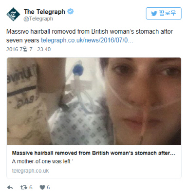 영국 여성이 머리카락 뭉치 제거 수술을 받은 뒤 안정을 취하고 있다./출처=텔레그래프 트위터 캡쳐
