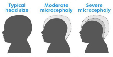 정상 신생아의 두뇌 크기와 경증 및 중증 소두증 신생아 두뇌 크기 비교./위키피디아캡처