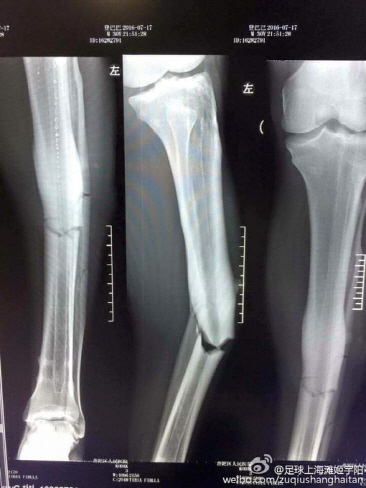 뎀바 바의 골절된 다리 X-ray./출처=트위터 캡쳐