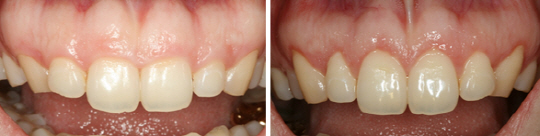 치아를 많이 덮고 있는 잇몸(왼쪽)을 치료한 후 모습.