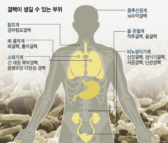 결핵이 생길 수 있는 부위