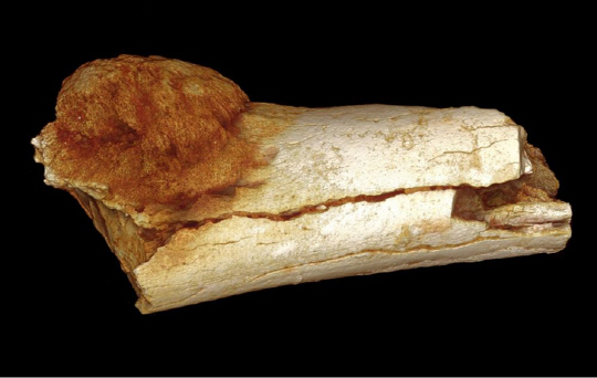 [170만년전 악성 종양을 포함하고있다고 추정되는 인류의 발뼈] 사진: popular science 제공