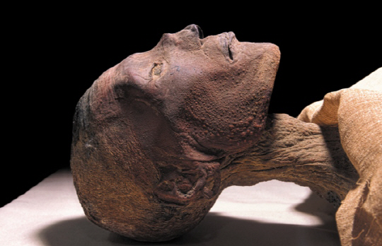 기원전 1,157년에  사망한 람세스 5세 미라. 미라의 얼굴에는 천연두를 앓은 흔적인 곰보 자국이 선명하게 남아 있다.