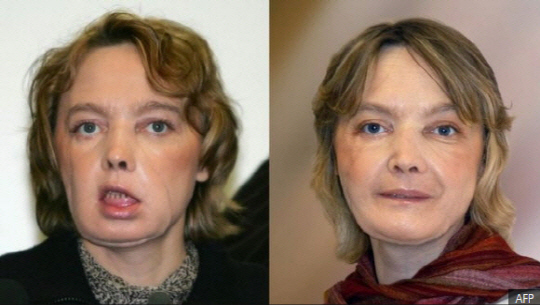 안면 이식 수술을 받은 지 한 달 정도 지난 2006월 초의 디누아르의 모습(왼쪽)과, 수술 8개월 뒤의 모습(오른쪽). /사진=AFP
