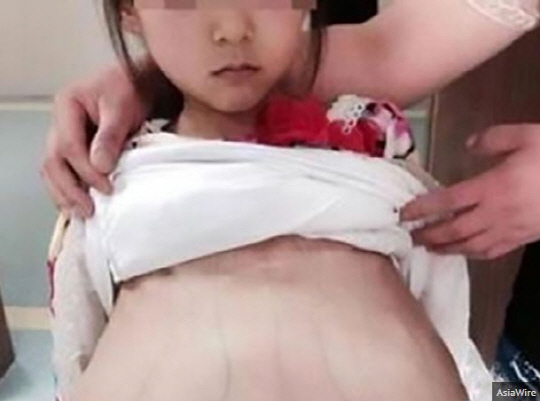 임신한 12세 소녀를 20세라고 속인 중국 40대 남성 체포