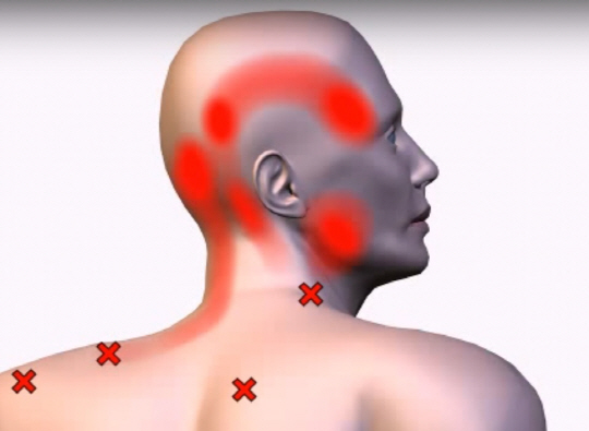 통증의 시작점은 목 주변의 뭉친 근육(X로 표시된 통증유발점)이지만, 통증이 느껴지는 곳은 두피와 머리다. 목 근육이 주변 신경을 누르면 머리로 연결된 신경이 통증을 느낀다.