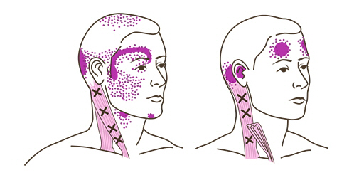 흉쇄돌기근(X표시)이 딱딱하게 뭉치면 관자놀이, 눈, 정수리 부위에 두통이 생긴다.