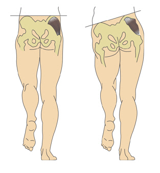엉덩이 근력이 정상인 걸음(왼쪽)과 엉덩이 근육이 약해 골반이 틀어진 걸음.