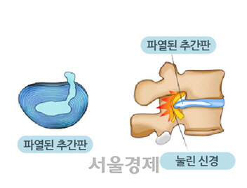 허리 디스크(추간판) 탈출증 개념도