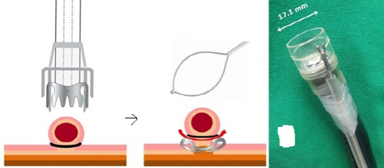 위점막밑층 종양제거술  특수 내시경(오른쪽)으로 위 점막 밑층에 생긴 종양부위를 복주머니처럼 묶고 그 아래 위벽 전층을 클립으로 봉합한 뒤 중간에 올가미를 씌워 종양을 제거한다. 내시경엔 봉합기구와 투명 캡이 달려 있다.