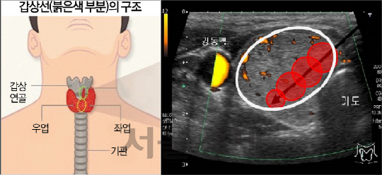 갑상선에 생긴 혹(오른쪽 흰색 큰 타원)을 찍은 초음파 영상. 화살표와 붉은 색 작은 원은 고주파 바늘(전극)을 찔러 치료할 부위다. 경동맥 등 혈관이나 신경이 손상되지 않게 주의해야 한다. /사진제공=대림성모병원