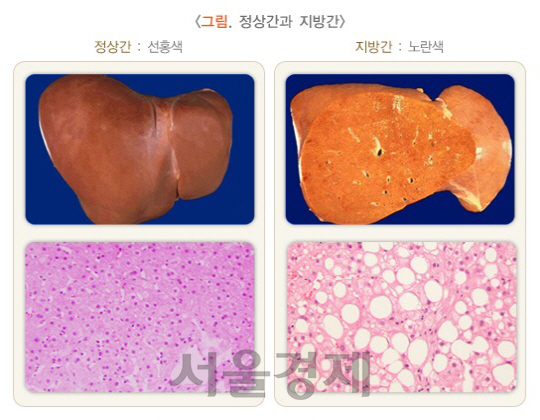 정상 간(왼쪽)과 지방 비율이 높아진 지방간. /사진제공=대한간학회