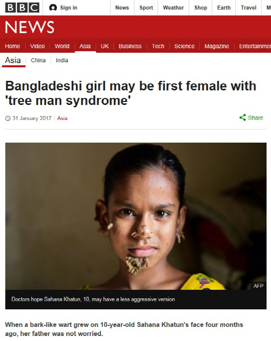 방글라데시서 ‘나무인간병’ 의심 환자 발생…‘첫 여성 발병 사례’