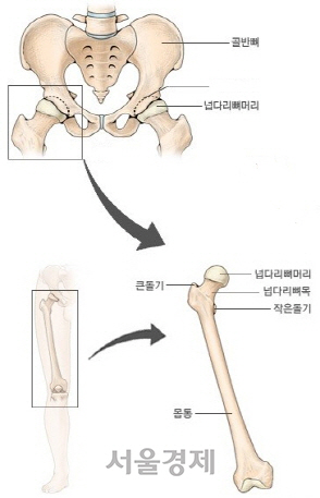 엉덩관절(고관절)과 넙다리뼈(대퇴골). 골다공증에 걸리면 넙다리뼈의 윗부분이 잘 부러진다.