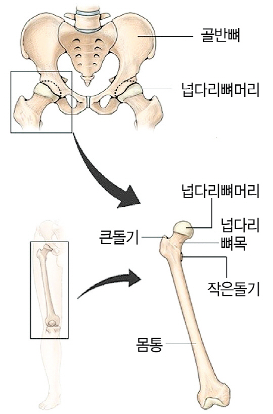 엉덩관절(고관절)과 넙다리뼈(대퇴골). 골다공증에 걸리면 넙다리뼈의 윗부분이 잘 부러진다.