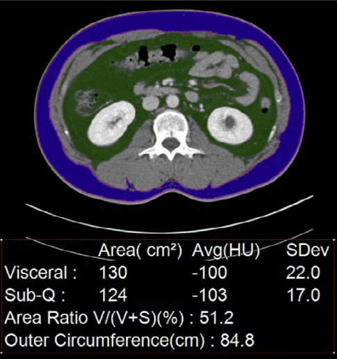 비알코올성 지방간이 있는 33세 남성의 내장지방(초록색), 피하지방(파란색) 면적 등을 측정한 컴퓨터단층촬영(CT) 영상. 복부둘레가 84.8㎝(33.4인치)인데 내장지방 면적이 130㎠로 평균(70㎠)보다 87% 많다. 간의 23%가량이 지방화돼 지방간 진단 기준(5%)의 4.6배나 된다.