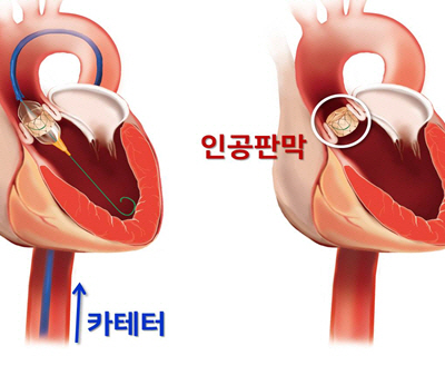 제대로 닫히지 않는 대동맥판막을 가슴을 열지 않고 인공판막으로 교체하는 ‘경피적 대동맥판막치환술(TAVI)’의 개념도.