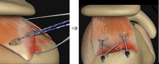 부분 파열·위축된 회전근개를 특수 나사와 실로 당긴 뒤 봉합수술을 한 모습. /개념도=달려라병원