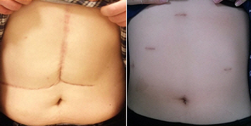 개복수술(왼쪽)과 복강경 수술(오른쪽)로 간을 떼어내는 수술을 받은 기증자의 수술 후 모습. /사진제공=서울대병원