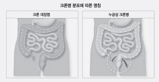 크론병이 어느 부위에 분포됐느냐에 따라 명칭이 다르다. 회장과 대장에 함께 발병하면 크론 회대장염, 대장 전체에 퍼지면 크론 대장염, 장에 염증이 생겨 구멍이 나는 ‘누공’ 증상이 발생하면 누공성 크론병이라 부른다. /출처=보건복지부 국민건강정보포털