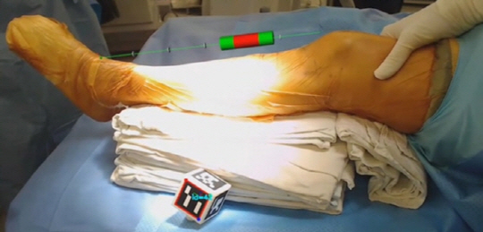 정강이뼈에 발생한 골종양의 위치를 증강현실 시스템을 이용해 보여준 태블릿PC 화면. 빨간색으로 표시된 부분이 종양의 위치다. /사진제공=분당서울대병원