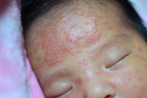아토피 피부염을 앓고 있는 어린아이의 얼굴. /서울경제DB