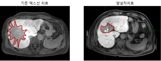 간세포암 환자를 X선과 양성자빔으로 치료하는 과정에서 손상된 간 부위(빨간선 내 짙은 회색 부분). 양성자 치료 때 손상 범위가 훨씬 적다.  /사진제공=삼성서울병원