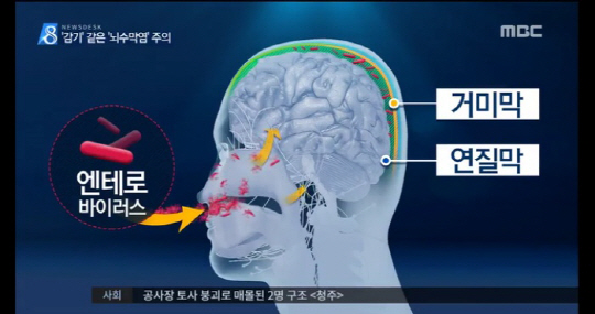 바이러스수막염 환자 7월 급증…9세 이하 개인위생 주의해야