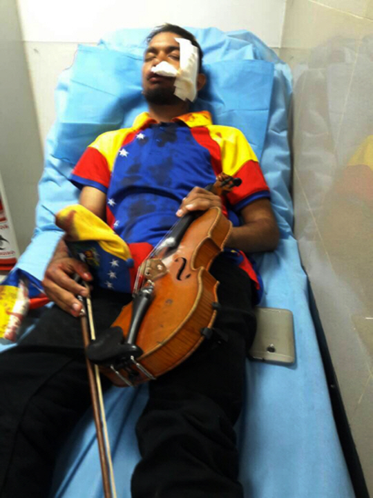 베네수엘라 반정부 시위 현장에서 바이올린을 연주해 ‘평화 시위의 아이콘’으로 불렸던 우일리 아르테아가(23)가 지난 22일(현지시간) 얼굴에 산탄을 맞아 부상을 입은 채로 수도 카라카스의 병원 침대에 누워있다.  /카라카스=AFP연합뉴스
