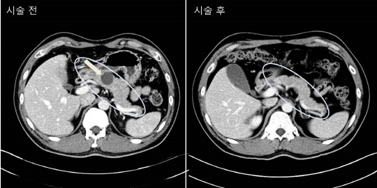 내시경초음파로 췌장 낭성종양 제거술을 받기 전후의 CT 영상. 시술로 낭성종양(화살표)이 없어졌다.