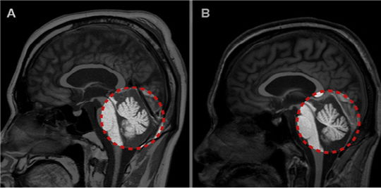 열사병 직후(왼쪽)와 2개월 뒤의 자기공명영상(MRI) 사진. 2개월 뒤 사진에서 붉은 점선 안 소뇌가 위축된 ‘지연선 소뇌손상’이 확인된다. /사진제공=분당서울대병원