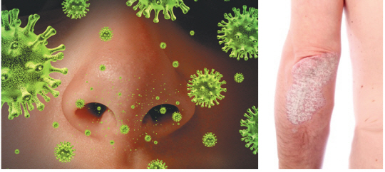 가을에 더 심한 알레르기 비염 이미지(왼쪽)와 건선 환자의 팔꿈치 부위에 생긴 두터운 은백색 각질.  (출처: 이미지투데이, 건강보험심사평가원)