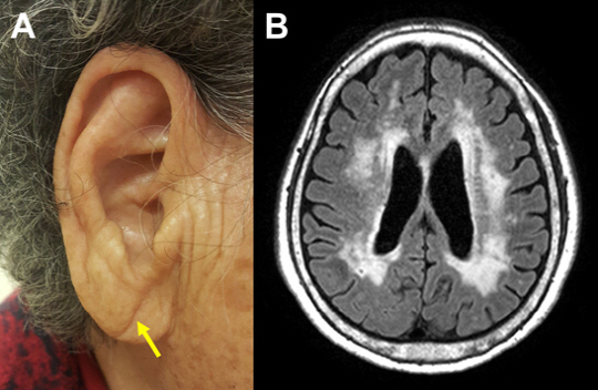 귓불 아래쪽에 생긴 ‘대각선 주름’(왼쪽)은 치매·심장질환의 신호가 될 수 있다. 대각선 귓불주름이 있는 인지장애 환자 중 69%는 미세혈관이 막혀 뇌가 하얗게 변성(오른쪽)되는 혈관성 치매가 원인이었다. /사진제공=경희대병원