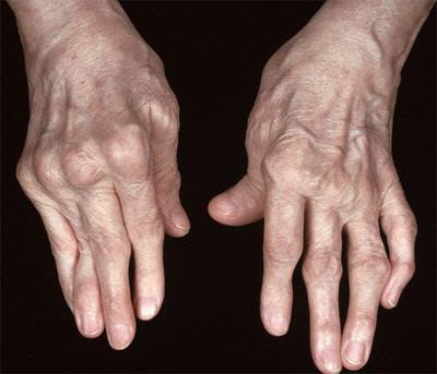 류머티즘 관절염 환자의 손