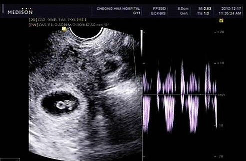 미국 ‘첫 자궁이식’ 출산 성공! 이식 4명 중 1명 출산, 1명 임신 “남자도 가능? 무서운 기술력”