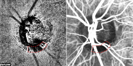 녹내장 환자의 시신경에 산소·영양을 공급하는 혈관을 빛간섭단층촬영(왼쪽)과 조영제를 혈관에 주사한 뒤 실시하는 혈관조영검사로 찍은 영상. 붉은색 점선으로 둘러싸인 부분이 혈류저하 영역인데 서로 일치한다. /사진제공=분당서울대병원