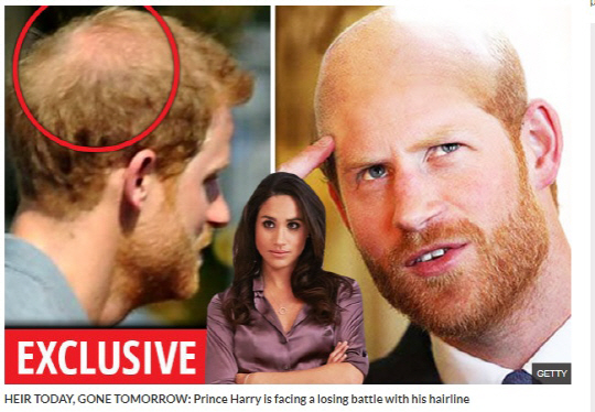 영국의 신문 데일리스타는 지난 10일 해리 왕자의 탈모에 관련한 기사를 실었다. /데일리스타 홈페이지 캡처