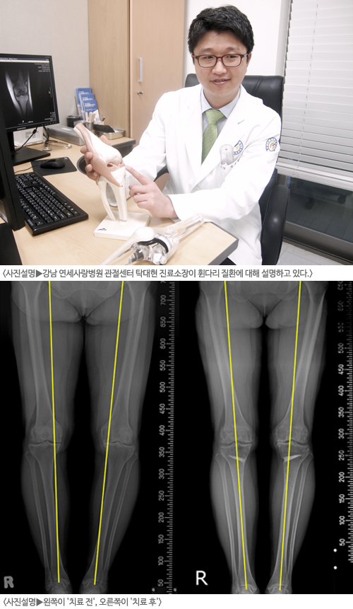 보존적 ‘휜다리 교정술’과 ‘줄기세포 치료’ 병행, O다리·무릎통증 동시 원인 치료
