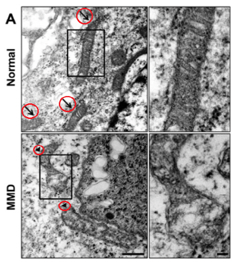 전자현미경으로 본 정상인 혈관내피 전구세포의 미토콘드리아(사진 위 화살표가 가리키는 부분)와 모야모야병 환아의 비정상적 미토콘드리아(아래 화살촉이 가리키는 부분). /사진제공=서울대병원
