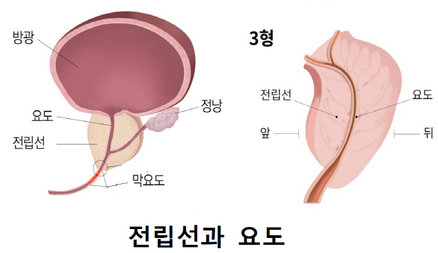 전립선암 재발 막으려면 로봇수술이 유리