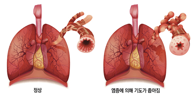 [봄철 건강관리] 미세먼지·황사…눈·코·기관지에 더 잔인한 3월