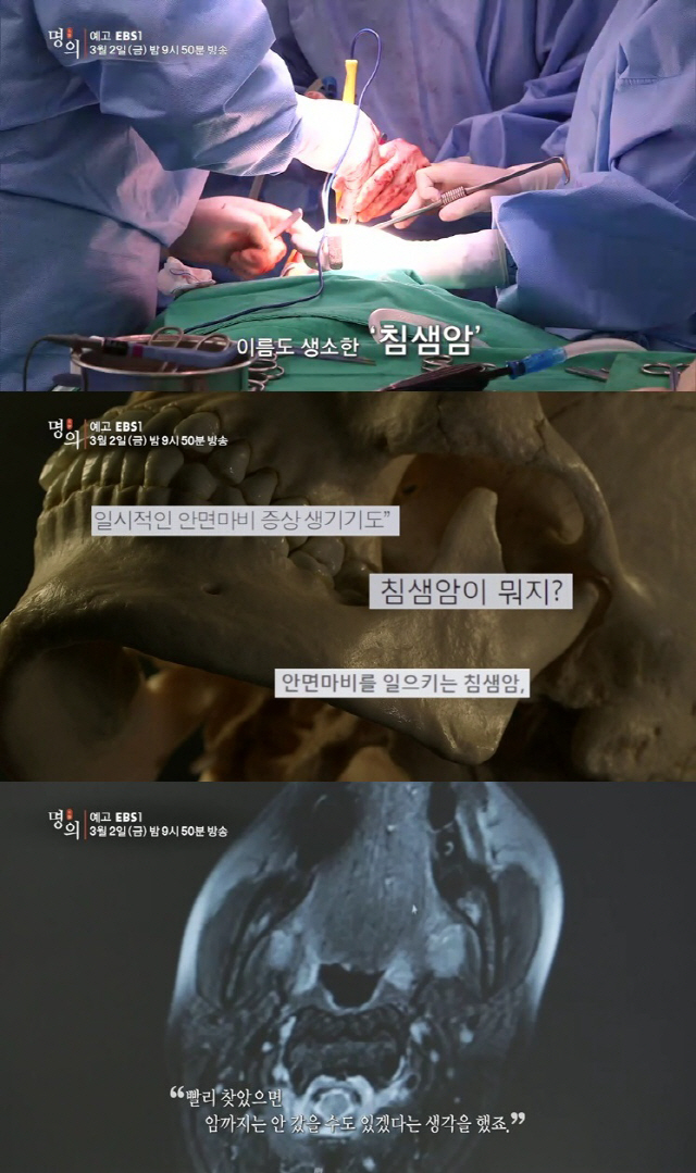 ‘명의’ 입속의 암 ‘침샘종앙’, 조기진단부터 치료방법, 후유증 해결까지