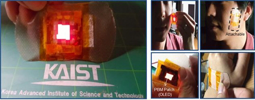 KAIST와 서울대 분당병원 공동연구팀이 개발한 웨어러블 OLED 광치료 패치. /연합뉴스=한국연구재단 제공