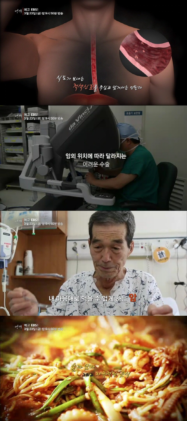 ‘명의’ 평범한 삶 앗아가는 ‘식도암’, 예방법과 치료법 소개