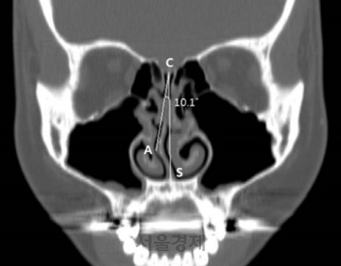 코골이와 수면무호흡증을 앓는 환자의 코 주변 컴퓨터단층촬영(CT) 영상. 콧구멍 칸막이뼈(비중격)가 오른쪽으로 10.1도 휘어져 있어 코로 숨 쉬는 데 어려움이 있다. /사진제공=서울대병원